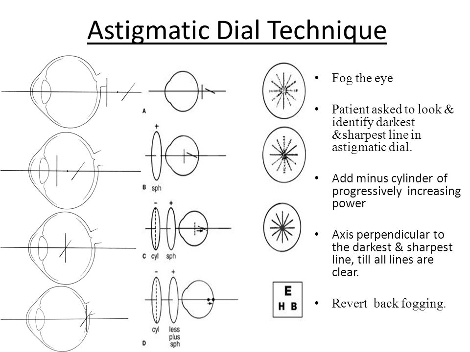 Astigmatic Dial Technique