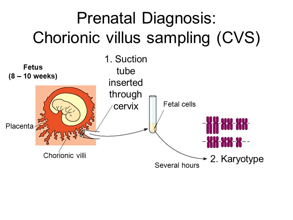 Prenatal Diagnosis: Chorionic villus sampling (CVS)