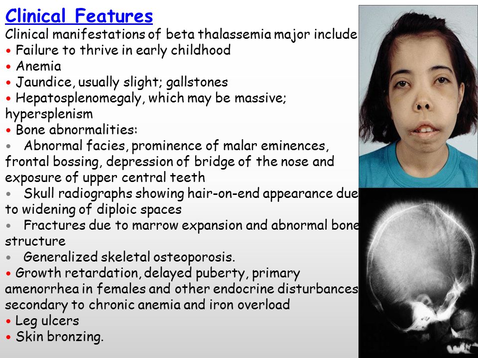 Thalassemia Syndromes - ppt video online download