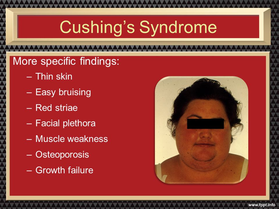 Cushing's Syndrome Hasan AYDIN, M.D. Endocrinology and Metabolism - ppt  download