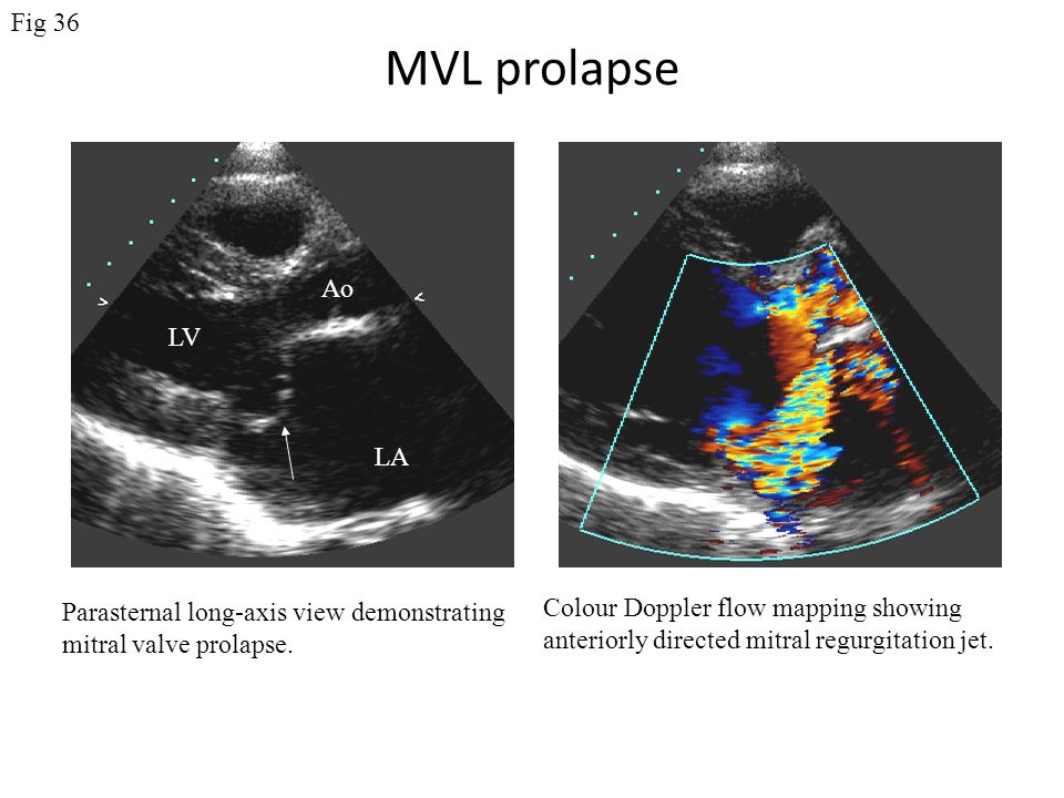 MVL prolapse Fig 36 Ao LV LA Colour Doppler flow mapping showing