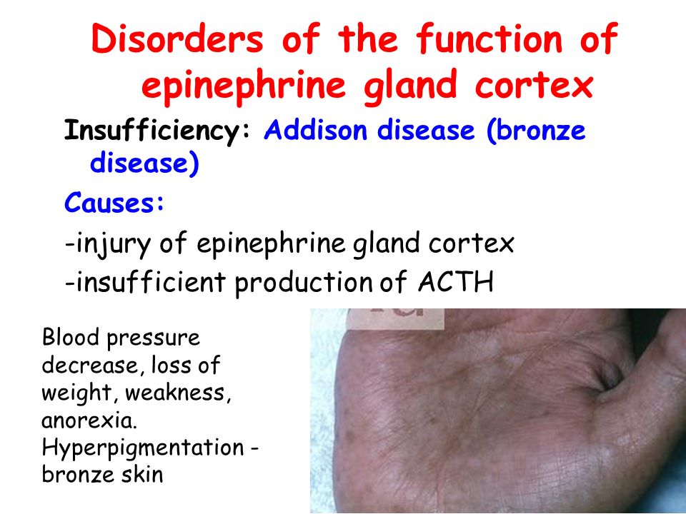 Disorders of the function of epinephrine gland cortex