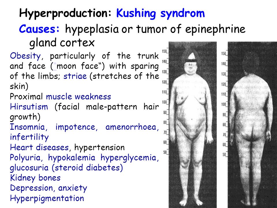 Hyperproduction: Kushing syndrom