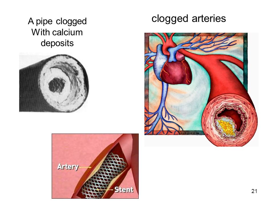 clogged arteries A pipe clogged With calcium deposits
