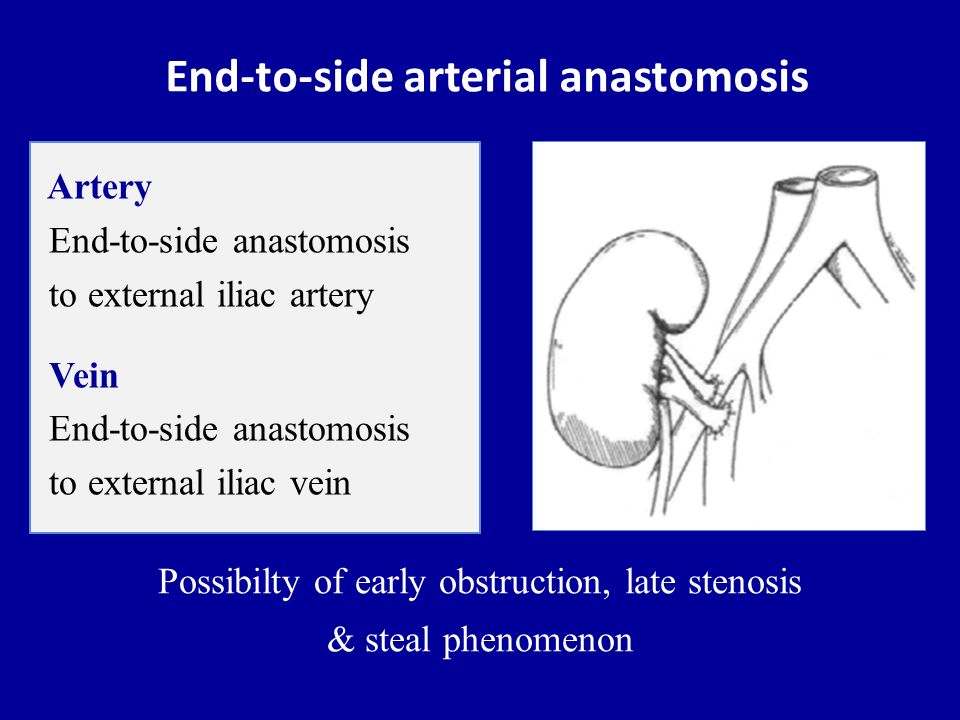 End-to-side arterial anastomosis