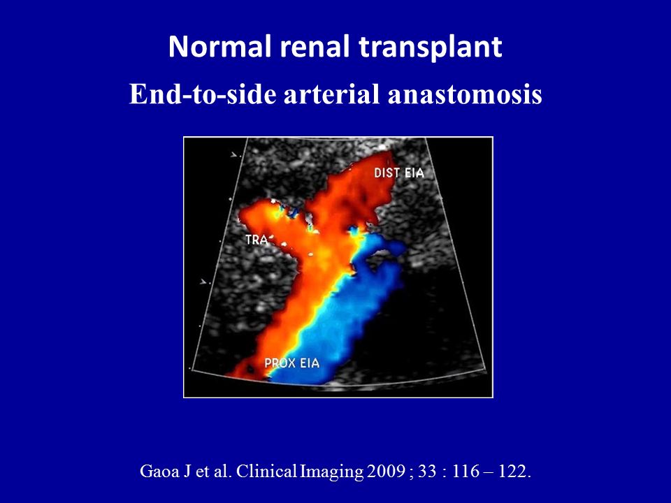 Normal renal transplant End-to-side arterial anastomosis