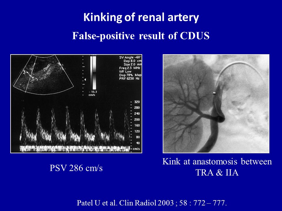 Kinking of renal artery False-positive result of CDUS