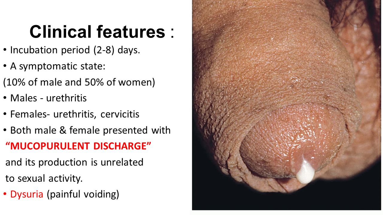 Urethral Discharge in Females  8 Causes for Urethritis in Women