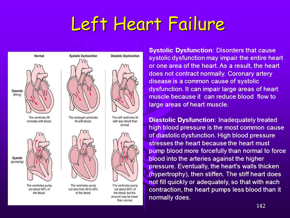 Left Heart Failure