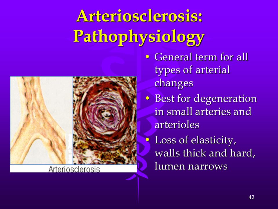 Arteriosclerosis: Pathophysiology