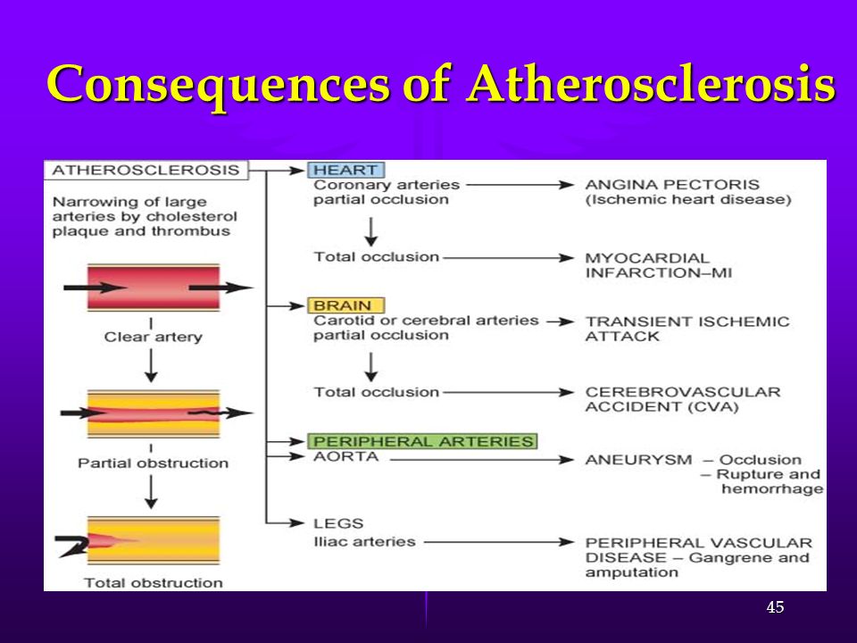 Consequences of Atherosclerosis