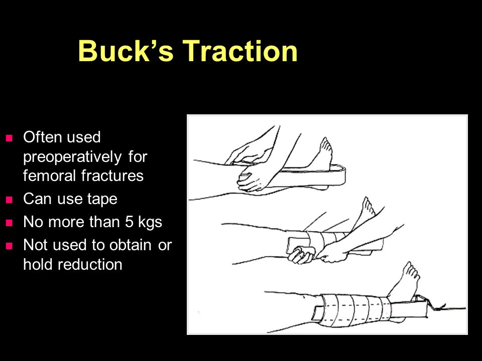 Bucks Traction