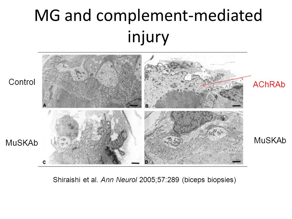 MG and complement-mediated injury