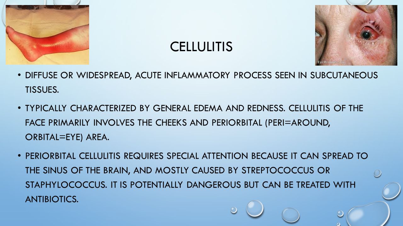29 cellulitis ...